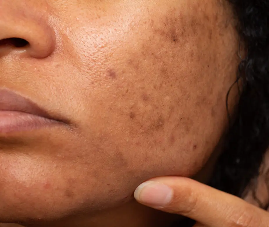 Pigmentation Treatment